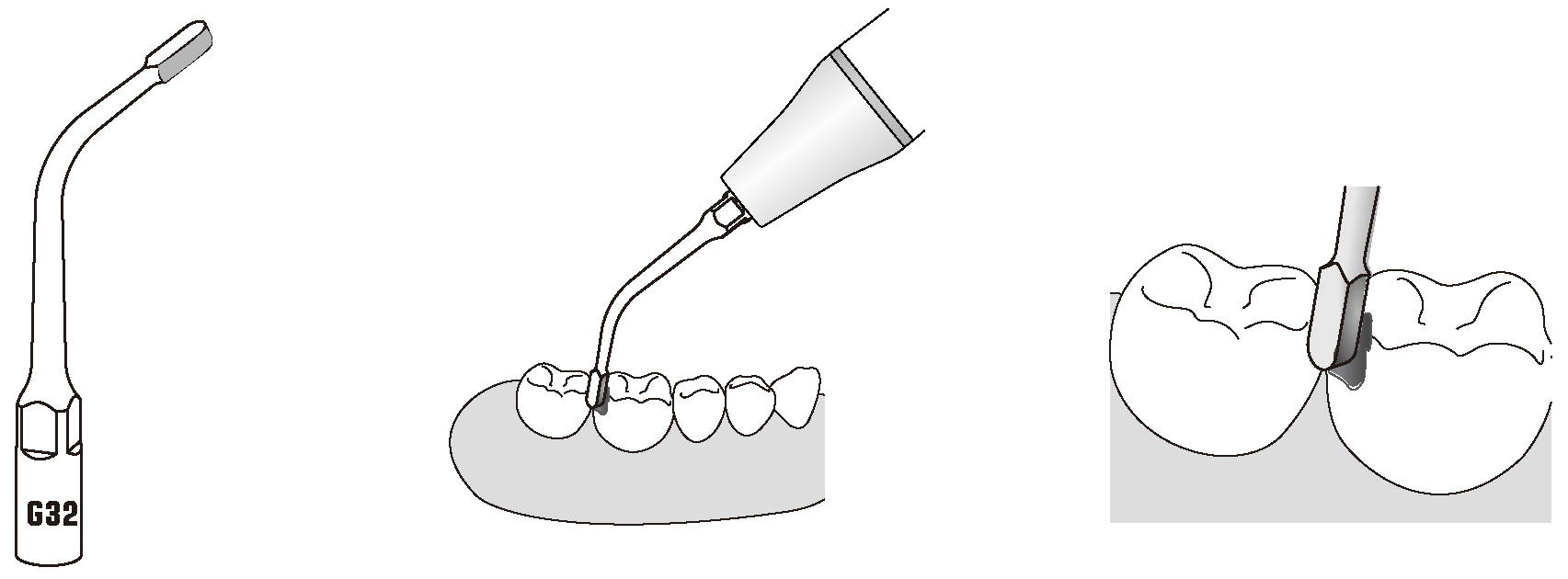 Сфера применения наконечника для скалера